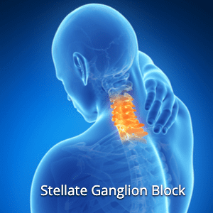 Stellate Ganglion Block